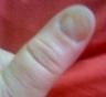 Twinkle's Thumb/nail changes