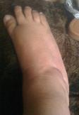 Twinkle's CRPS discoloration Right Foot